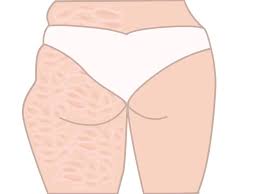 All exercise for legs melt cellulite fat deposits on legs and thighs removing symptoms of cellulite fighting the causes of cellulite on front of thighs allowing you to get rid of thigh cellulite with only thigh cellulite exercises in two weeks and fight cellulite fast to be pretty and very attractive again and become hissecretobsession. 9 Simple Exercises To Get Rid Of Cellulite On Buttocks