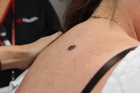 The Seven Different Types Of Melanoma Skin Cancer