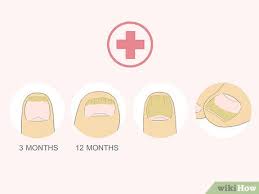 Causas dos fungos na unha do dedo do pé. 3 Formas De Se Livrar De Fungos Nas Unhas Wikihow