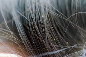 The early 20th century continued the advances of the industrial revolution. What Does Head Lice Look Like Parents