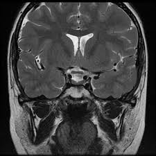 Pituitary Stalk Interruption Syndrome Radiology Case Radiopaedia Org