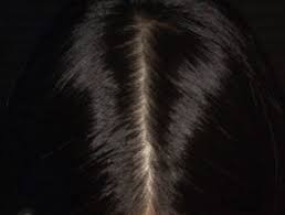 Thinning hair develops together with your physical development. Female Pattern Hair Loss Dermnet Nz
