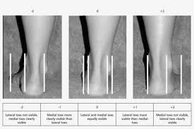 So, if a person has their arms abduction is any motion of the limbs or other body parts that pulls away from the midline of the body. The Evaluation Of The Abduction Adduction Of The Forefoot Foot Adduction Free Transparent Png Download Pngkey