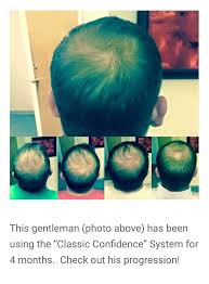 Biotin Hair Growth Before And After Pictures Men Perfect Product For Balding Men Monat Balding Men What Causes Hair Loss Hair Loss Men Hair Loss Regrowth