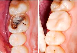 Trám sâu răng thì có tốn tiền và đau đớn gì không? Nha khoa Thùy Anh -  nhakhoathuyanh