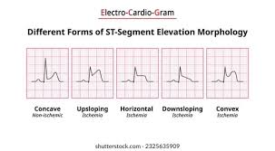 Image result for ST Segment