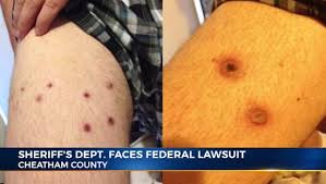 Redditor jenniferami posted 3 examples of taser/stun gun wounds that are very similar to those found on jbr's body I Ll Keep Doing That Until I Run Out Of Batteries Tennessee Sheriff S Deputies Torture Teenager With Stun Gun Boing Boing