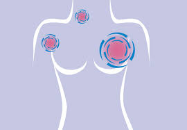 The sensation of a lump in the throat is called globus. Where Does Breast Cancer Spread Cleveland Clinic