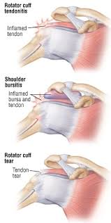 Image result for Rotator Cuff Injury