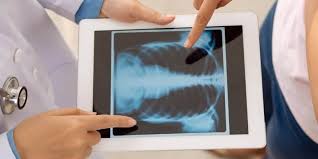 How Can I Tell If I Have A Broken Rib The Orthopedic Clinic