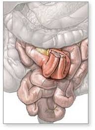 Pin On J Pouch Surgery