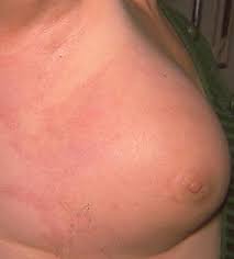 Other less common types of breast cancer include inflammatory breast cancer, medullary cancer, phyllodes tumor, angiosarcoma, mucinous (colloid) carcinoma, mixed tumors, and a type of. Axillary Vein Thrombosis As The First Clinical Manifestation Of Inflammatory Breast Cancer Report Of A Case Springerlink