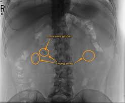 Pin On Lithotripsy