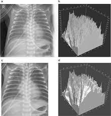 We did not find results for: An Anthropomorphic Phantom Representing A Prematurely Born Neonate For Digital X Ray Imaging Using 3d Printing Proof Of Concept And Comparison Of Image Quality From Different Systems Scientific Reports