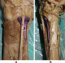 On the back of the hand, the tendons to the middle, ring, and little fingers are connected by two obliquely placed bands, one from the third tendon passing downward and lateralward to the second tendon, and the other passing from the same tendon downward and. Volar Locking Plates Not Touching The Flexor Pollicis Longus Tendon Appear As Prominences On Radiographs A Cadaver Study Journal Of Orthopaedics And Traumatology Full Text