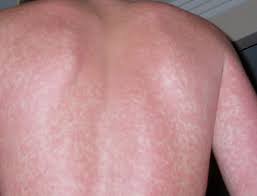 Could you have an alcohol allergy? Alcohol Allergy Allergic To Alcohol Alcohol Allergy Symptoms