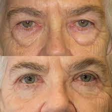 Pin On Eyelid Surgery Salt Lake City Utah