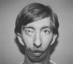 Occipito·Facio·Cervico.Thoraco. Abdomino·Digitale Dysplasie ODD·Syndrom;  ODDD Odontotrichomelie s. Spalthand mit OGUCHI·Syn