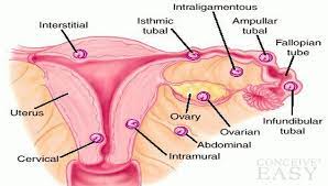 The incidence of heterotopic pregnancy (when both an intrauterine and an ectopic pregnancy are present) varies from 1 in 4,000 women to 1 in 30,000 women in the general. Can I Get Pregnant After An Ectopic Pregnancy Conceiveeasy Com