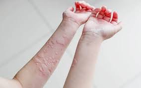 Folliculitis appears as shallow little bumps, and can feel itchy and sore, according to the mayo clinic. Breaking Out In An Itchy Rash You Could Have Urticaria Free Malaysia Today