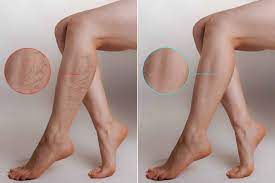 How To Get Rid Of Varicose Veins And Spider Veins