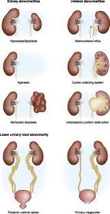 Clinical Integration Of Genome Diagnostics For Congenital Anomalies Of The Kidney And Urinary Tract American Society Of Nephrology