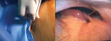 Although palmer's point approach is described for upper urinary tract laparoscopy, we use this technique routinely for robotic and standard laparoscopic radical prostatectomy and we describe our. Latif S Point A New Point For Veress Needle Insertion For Pneumoperitoneum In Difficult Laparoscopy Abd Ellatif 2018 Asian Journal Of Endoscopic Surgery Wiley Online Library