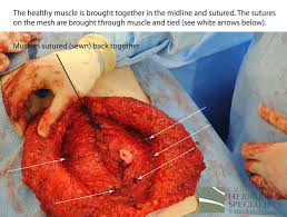 Check spelling or type a new query. Hernia Types Recurrent California Hernia Specialists