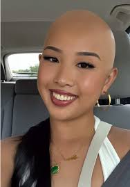 Cómo tratar las áreas con calvicie