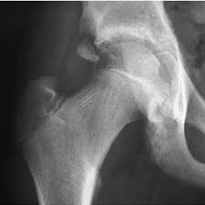 An avulsion fracture is a bone fracture which occurs when a fragment of bone tears away from the main mass of bone as a result of physical trauma. Pdf Injuries About The Hip In The Adolescent Athlete