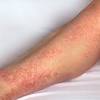 Nov 6, 2020 tinjau diabetes mellitus atau kencing manis adalah suatu penyakit kronis di mana kadar gula darah (glukosa) di dalam tubuh terlampau tinggi dan berada di atas normal. 1