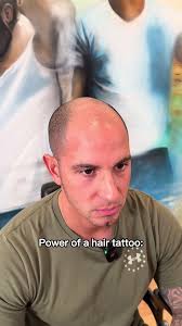 Transforming Alopecia with Scalp Micropigmentation