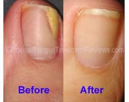 The apple cider vinegar will help. Apple Cider Vinegar For Nail Fungus Jpg You Can Get More Information About Nail Care At Purifythis Com Nail Fungus Cure Toenail Fungus Remedies Toenail Fungus
