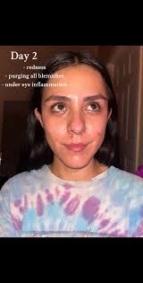 Before and After Radio Frequency Face