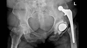 Image result for Hip Dislocation