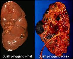 Buah pinggang adalah salah satu organ dalaman yang sangat penting untuk badan kita. 10 Tanda Tanda Buah Pinggang Anda Telah Rosak Iluminasi