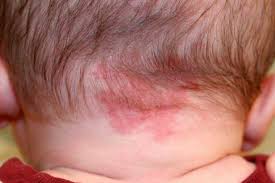 Kembalikan senyumnya dengan salep ruam popok terbaik! 13 Cara Hilangkan Ruam Bayi Panduan Lengkap 2019 Ethissa