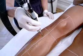 It is certainly possible to have darkening of the skin in the treated area after laser hair removal. Laser Hair Removal On Olive To Dark Skin With The Lyon Laser Centre