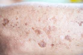 Image result for Solar Lentigo