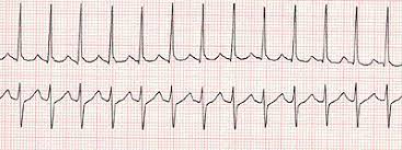 Supraventricular tachycardia (svt) is as an abnormally fast or erratic heartbeat that affects the heart's upper chambers. Clinical Practice Guidelines Supraventricular Tachycardia Svt