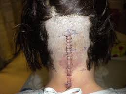Pin By Nicole Shambach On My Life With Chiari Malformation And Syringomyelia Chiari Chiari Malformation Brain Diseases