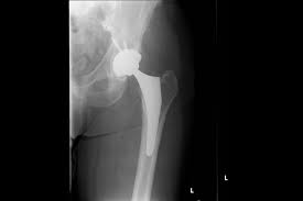 Hip revision (a repeat hip replacement) surgery involves replacing your artificial hip joint if it's become loose, infected or worn out. Thigh Pain 2 Years After Hip Replacement Surgery Clinical Pain Advisor