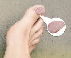 Image result for Koilonychia feet