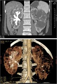Image result for Nephrolithiasis Imaging