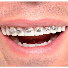 Diy braces is a dangerous and, in some cases, deadly trend that parents need to be aware of. Fool All Braces Teeth Party City