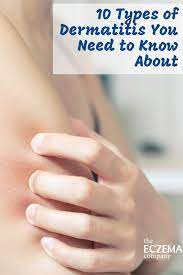 10 Types Of Dermatitis You Need To Know About Dermatitis Intense Itching Perioral Dermatitis