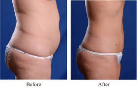 This can continue for 6 to 8 hours. Weight Loss Revision Wellness