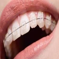 CERAMIC BRACES product image