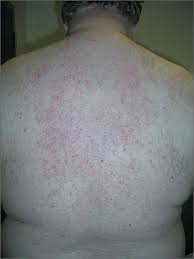Image result for sweat rash on back