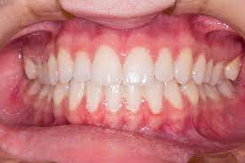 You want these symptoms treated before they become more severe. Tips To Keep Gums Healthy